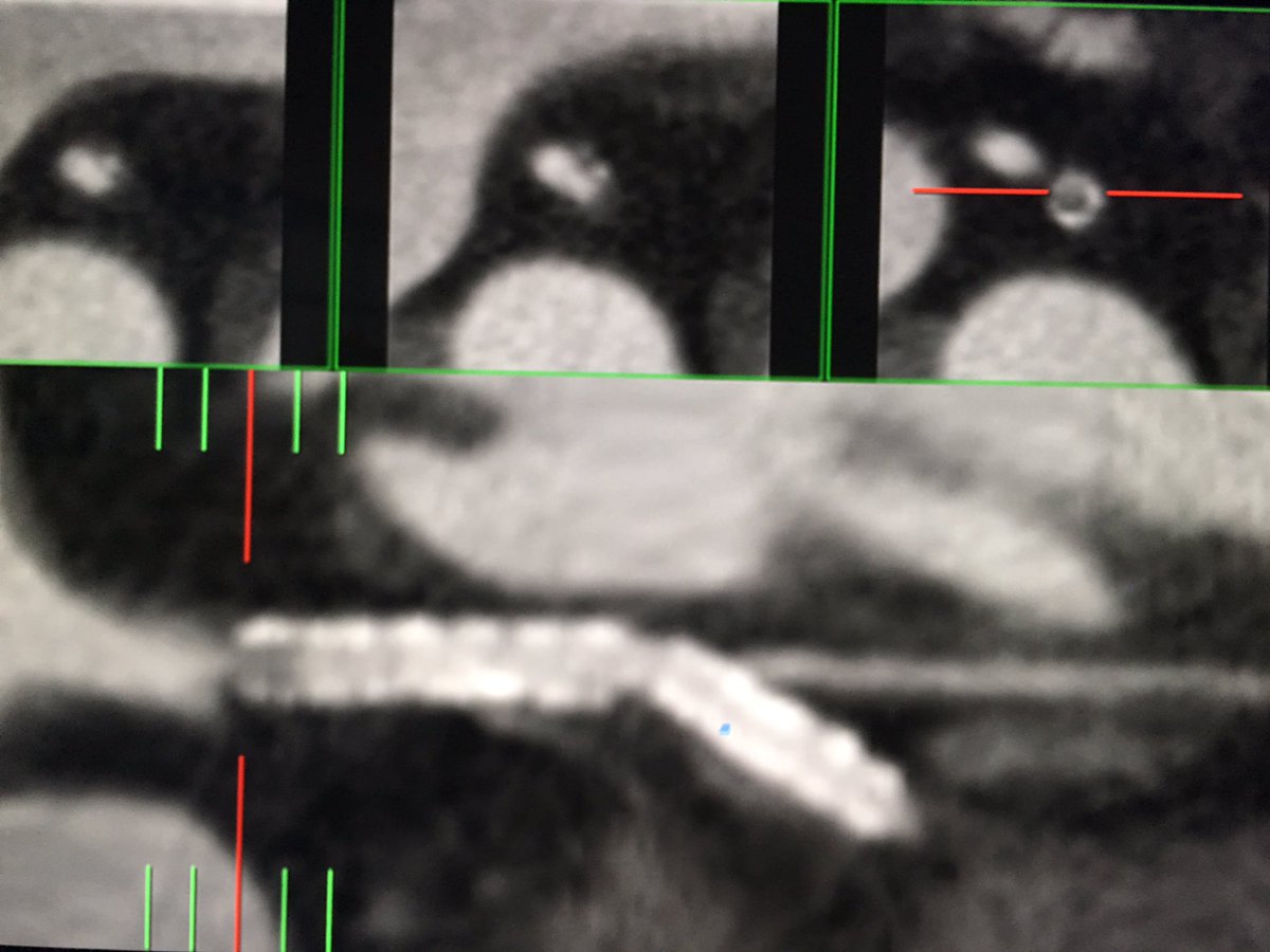 eliseovano's tweet photo. Reestenosis intra-stent. #CardioTAC perfectamente válido para stents proximales. #Radiologia #Cardiologia https://t.co/jKufhqaq6h