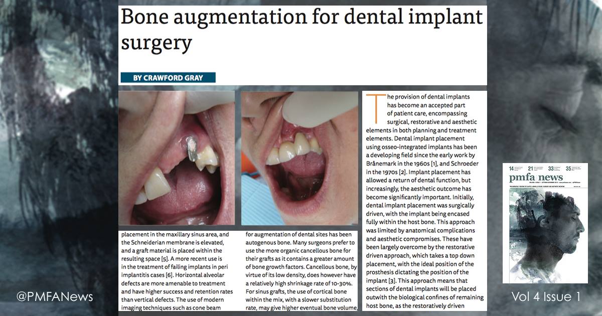 PMFAJournal's tweet image. Crawford Gray Tells Us Everything You Need To Know About #Boneaugmentation for #dentalimplant surgery bit.ly/2eYhgWl #PMFANews