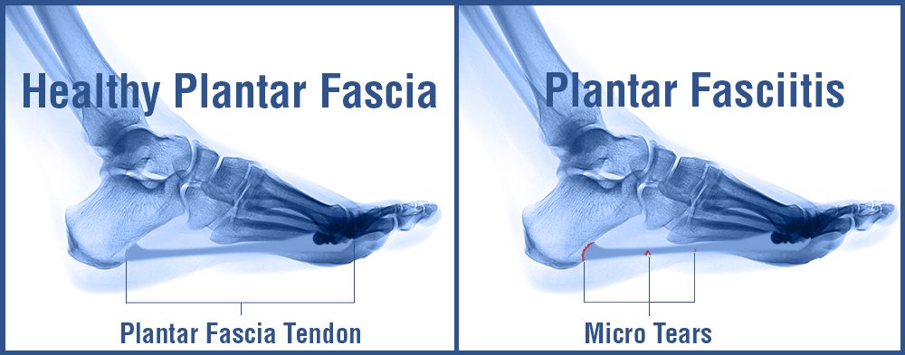 robertobarronpt's tweet photo. FASCITIS PLANTAR. VALORACION SENCILLA DE LA PROBLEMÁTICA Y PROPUESTA https://t.co/NFIq3Shj6N #CommonSenseTraining https://t.co/5Wfc4hOog2