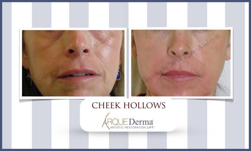 InjectAbility's tweet photo. #NonSurgicalFaceLift #Juvederm #Voluma #Restylane #Botox #NaturalResults #ClassicBeauty #Torrance #LosAngeles #SouthBay #ArqueDerma #NoPuff https://t.co/PcrodbjW1F