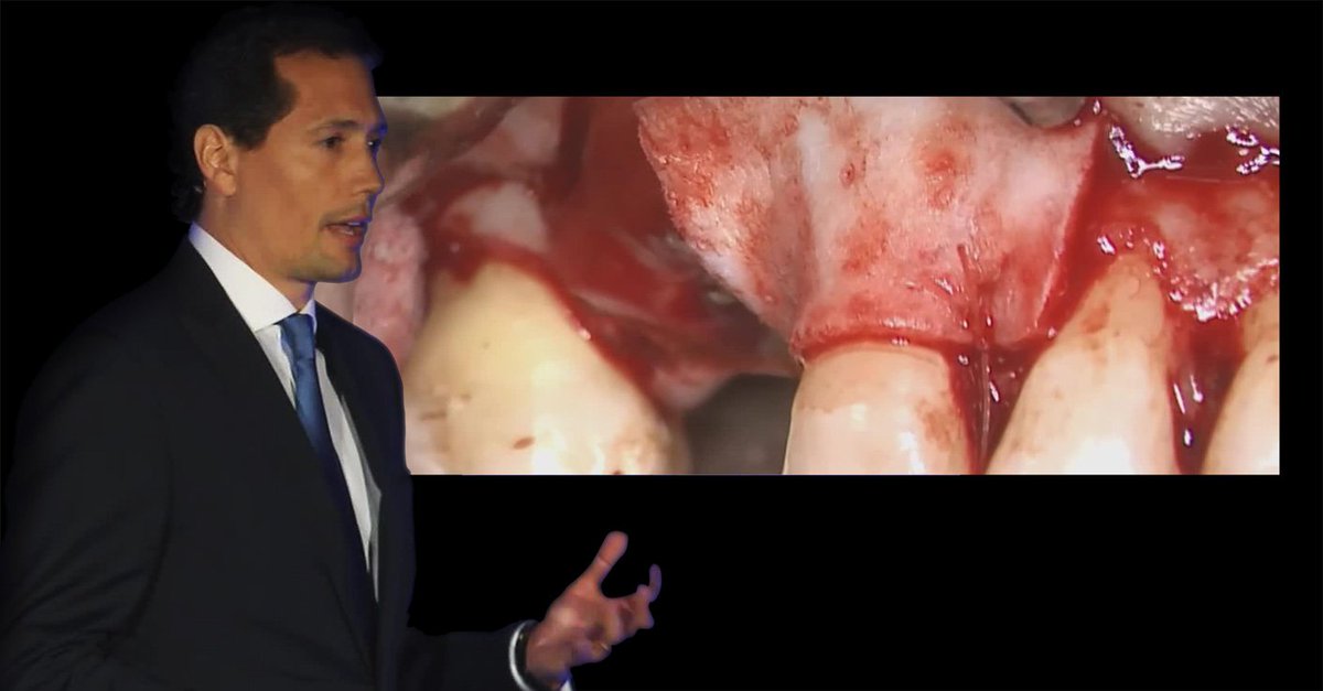 for_org's tweet photo. How to reconstruct #PeriimplantTissues? Dr.Tabanella shows you for free: https://t.co/JnAKXBgPiq #DentalAesthetics #SoftTissueManagement https://t.co/LxwivVJ59A