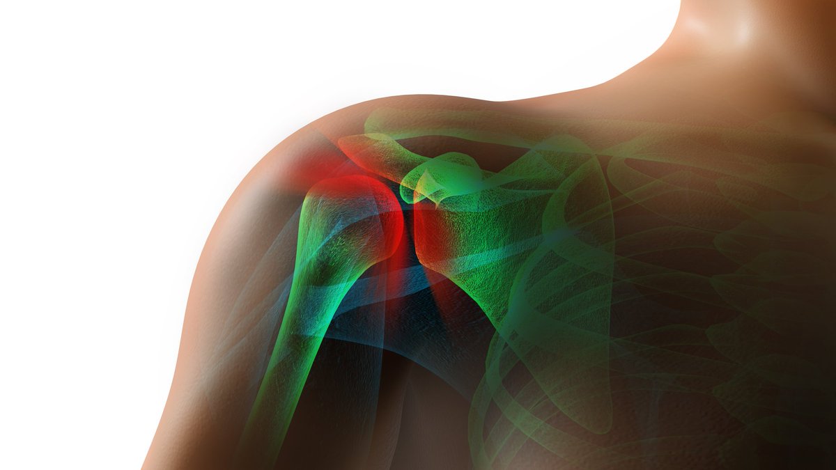 What is a frozen shoulder? ow.ly/LShz305nyY8 #AskDrK #jointpain