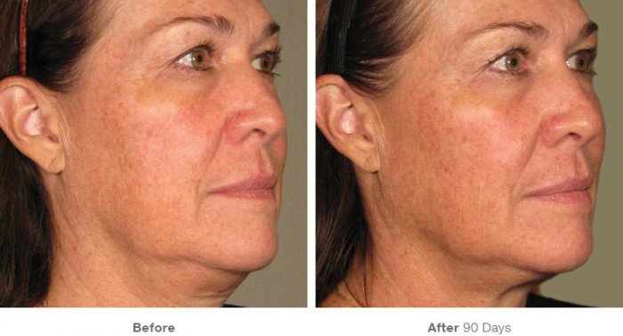 ChristineCBling's tweet photo. Loose, saggy skin no-more! My #Ultratherapy procedure made such a huge difference! https://t.co/bLaHwTg4kn ~ #DrChiu https://t.co/cx7d8XgV5v