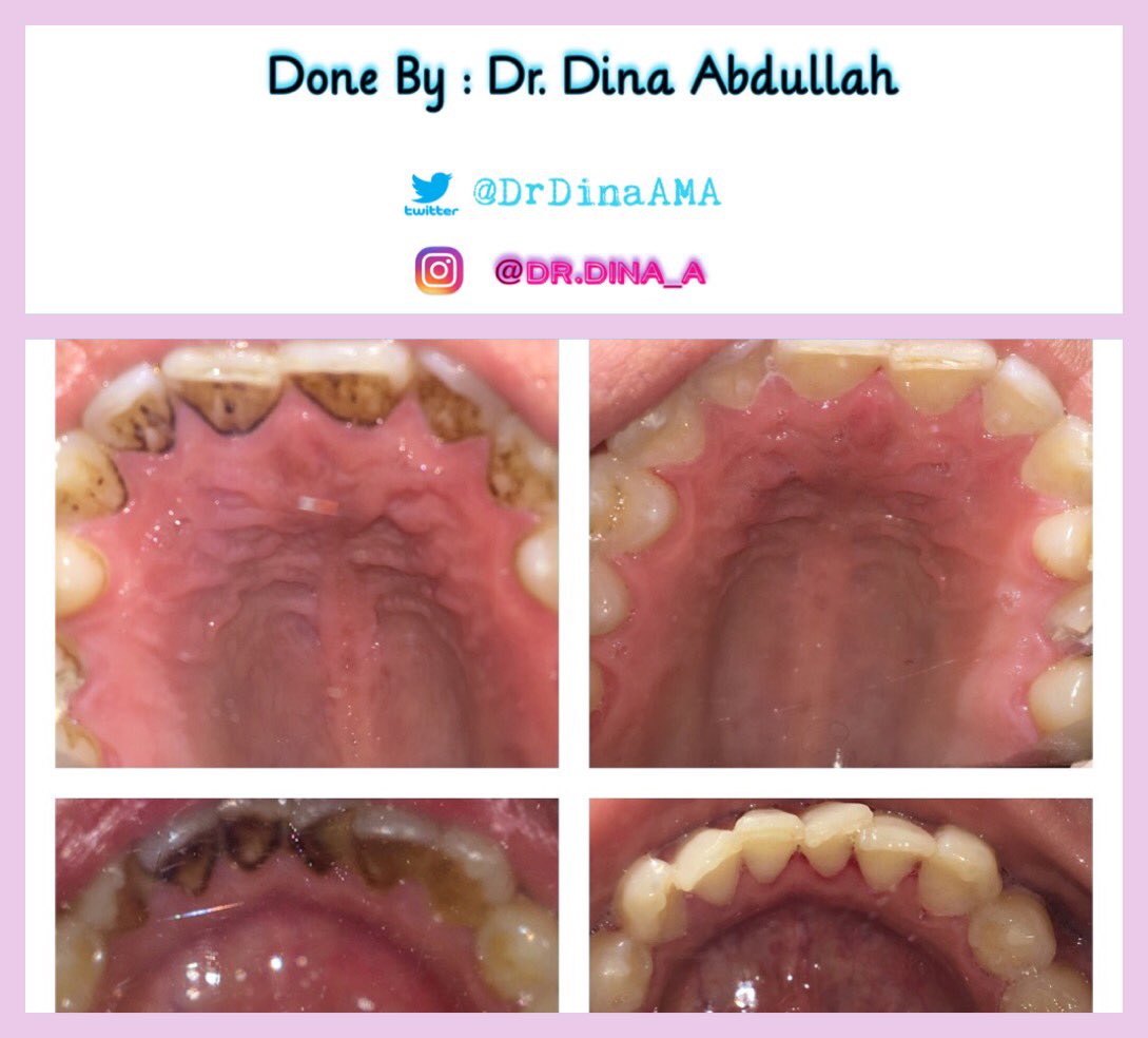 DrDinaAMA's tweet photo. Scaling .. remove the calculus , and stains . . @RiyadhCollegess 
#health #perio #teeth #rcdp https://t.co/qXX2uCrsvo