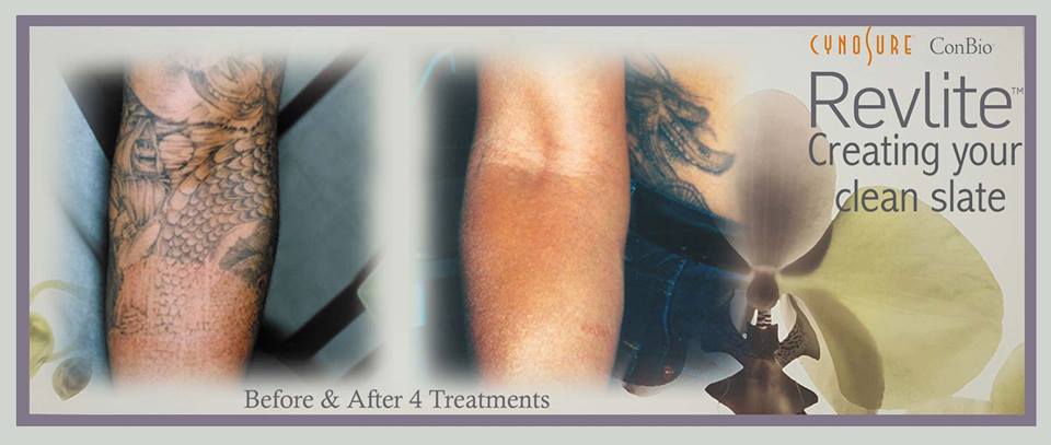 Immortalink's tweet photo. To book your free consultation, call our studio on 01245 493444. https://t.co/LBuejSbl2c