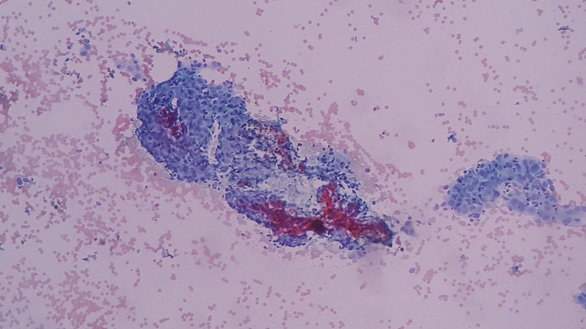 DrAppyNI's tweet photo. 60 yr old male with bilateral submandibular swelling.. #cytology #FNAC #Pathogy @aakasharmand @_SaranyaS_ @JMGardnerMD https://t.co/wvllDBscVE