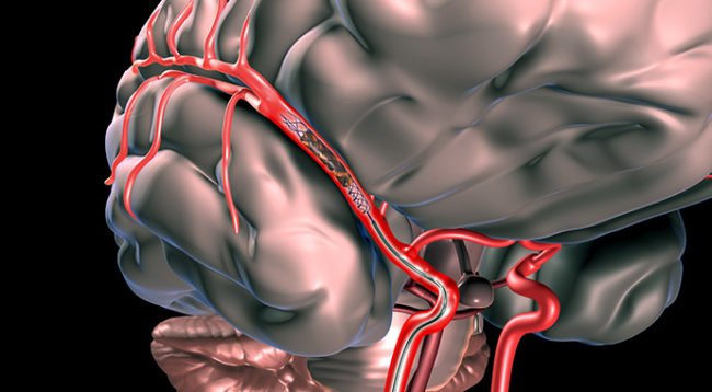 Randomized trials confirm the superiority of endovascular therapy for acute ischemic stroke cle.clinic/1JRPjpY