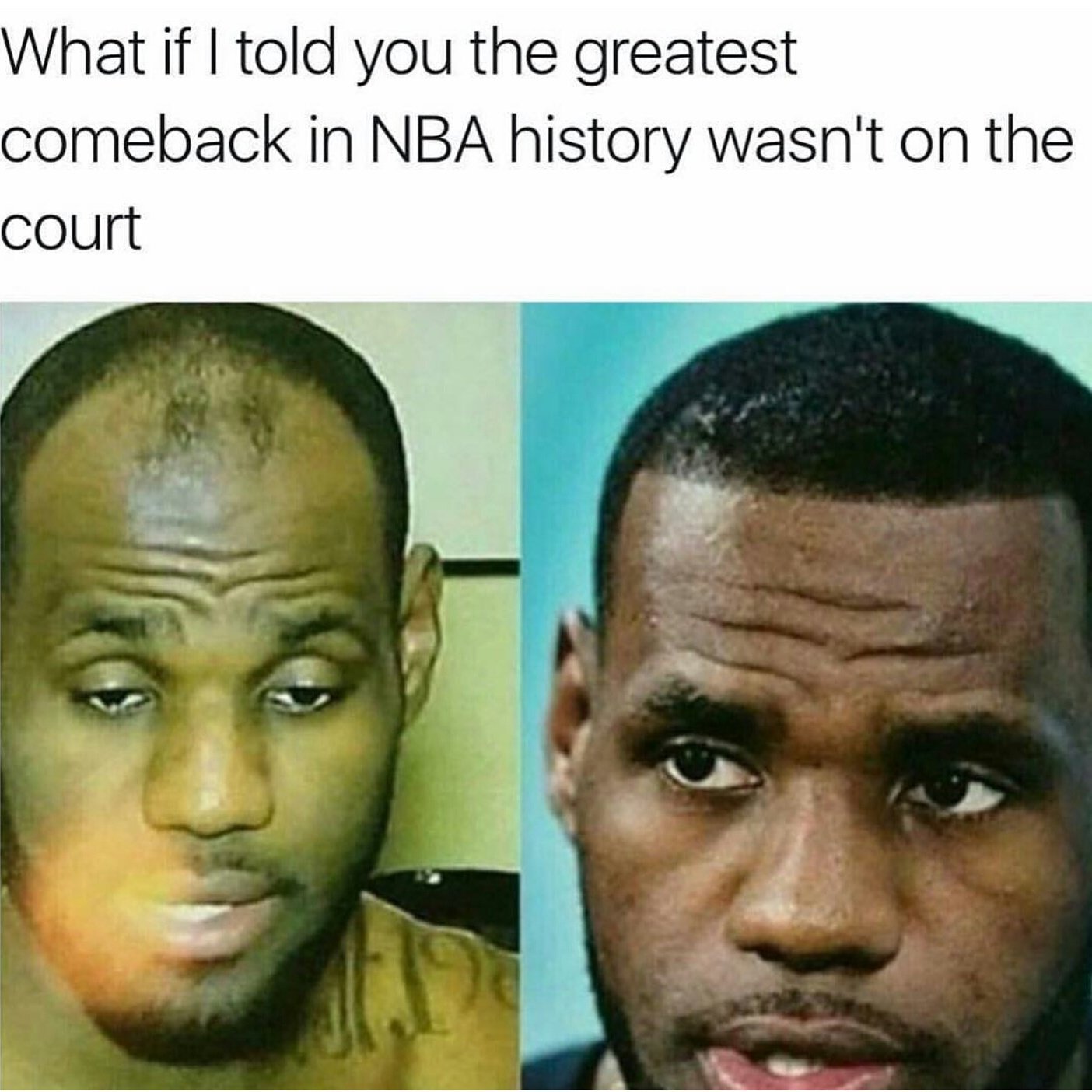 lebron hairline fixed