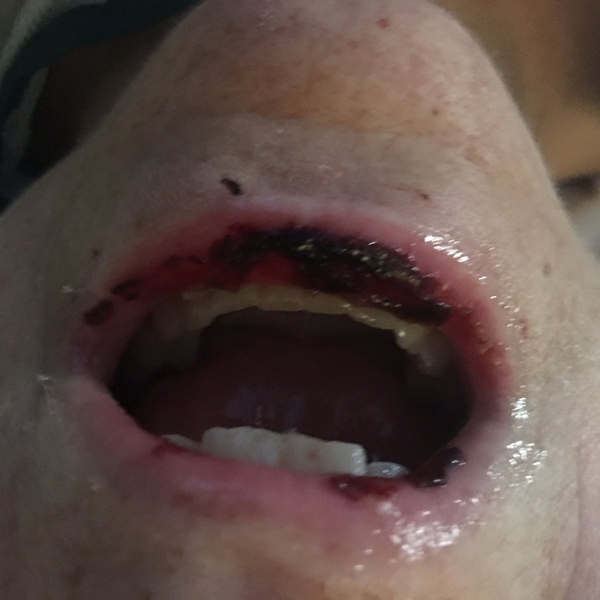 BBethJo's tweet photo. #BreastCancerRealityCheck Collateral damage from treatment can be severe. Sores extend throughout GI system. https://t.co/aeQuBWEaB8