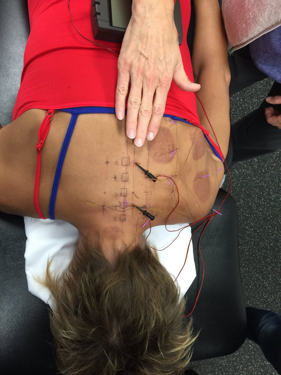TriPT2014's tweet photo. DN-1 day 3. Semistandardized approach to periscapular pain @DrDunning @DrSerafino #AAMT https://t.co/KbiRtBjRgV