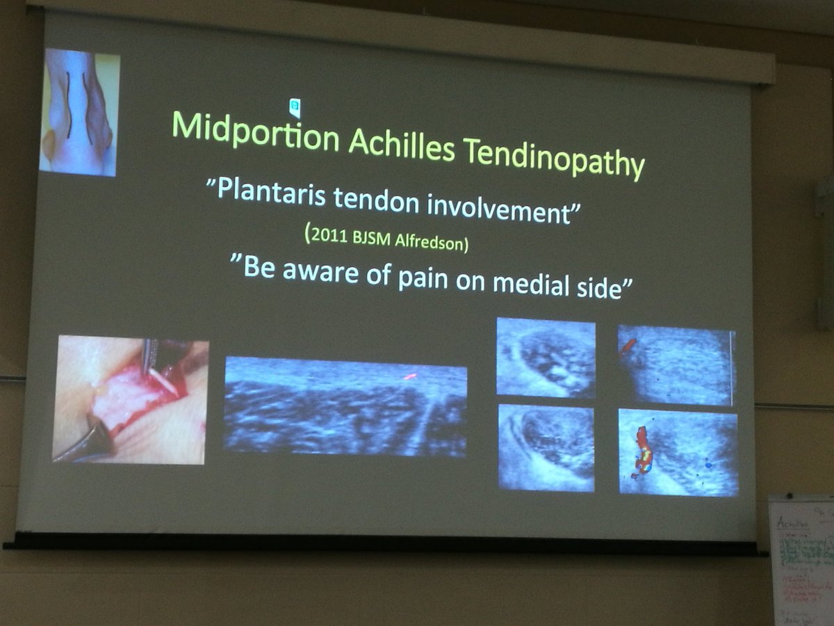 Medial Achilles pain. Watch out for Plantaris #tendons2016