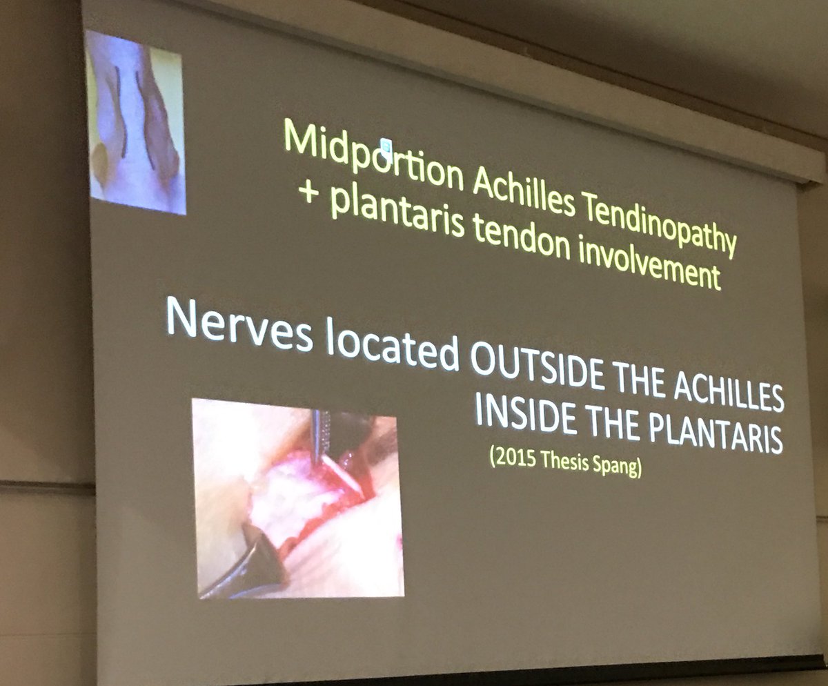 <a href="/HakanAlfredson/">Håkan Alfredson</a> <a href="/SpangChristoph/">Christoph Spang</a> nerves in side the plantaris tendon #tendons2016