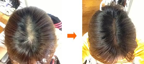 How海外fx Com 出産後やっぱり赤ちゃんに栄養が行っていたせいか 薄毛になってしまってました すっぽん小町をつかってから3か月 白髪と髪のボリュームが もどってきたー これは凄い 知り合いのママ友から教えてもらいよかったです How海外fx Com 出産後やっぱり赤ちゃんに栄養が行っていたせいか 薄毛になってしまってました すっぽん小町をつかってから3か月 白髪と髪のボリュームが もどってきたー これは凄い 知り合いのママ友から教えてもらいよかったです