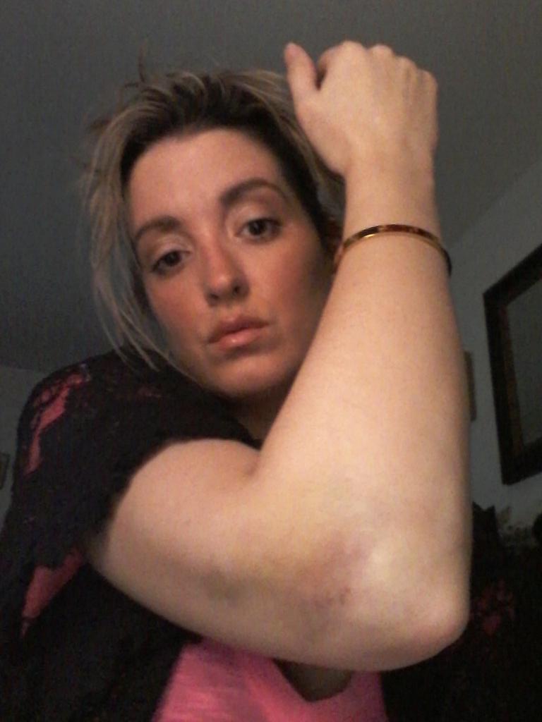 Iam_AmandaS's tweet photo. I was #attacked &amp; I #Defend #BlueLivesMatter The #PoliceOfficer ACTUALLY Interrogated ME! NOT
 HAPPY🚔😠 #dissapointed https://t.co/lnoqWkdtM4