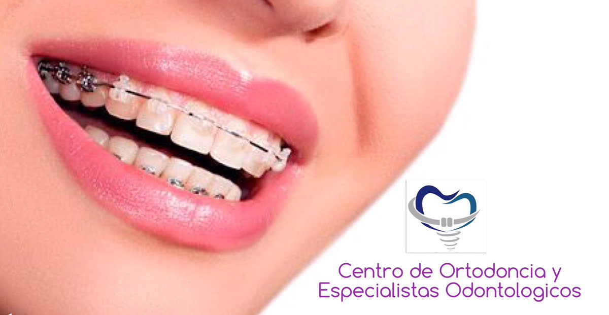 установка брекетов омск. самоподтягивающиеся брекеты. Mtx брекеты. красивые брекеты. брекеты на зубы ортодонтия.