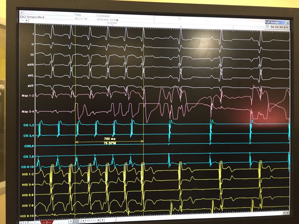 Concealed right posteroseptal inside CS os. Term within 1 sec RF onset. TCL 200ms