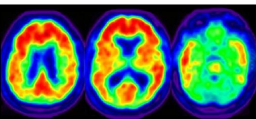 Neuroscience_LR's tweet photo. The origin of depression https://t.co/OWnGFF6VWc via @brendaLKK #OrbitofrontalCortex #MRI https://t.co/NLFFm3E3yn