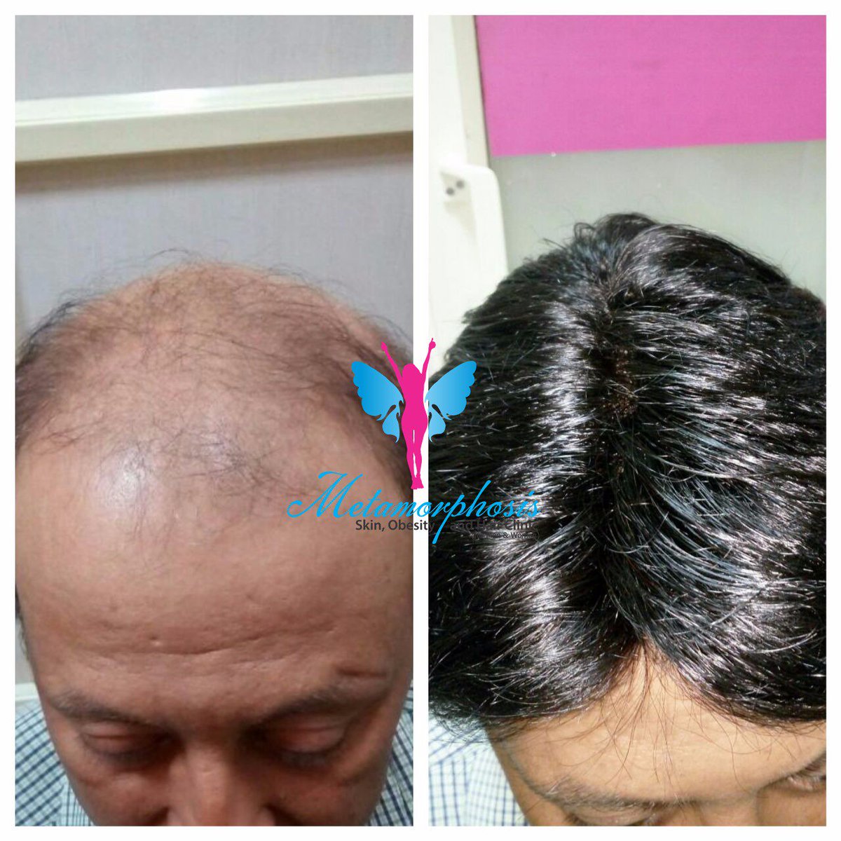 metamorphosisc9's tweet photo. Instant hair in just 2 hours #besthairclinic #hairbonding Mumbai #hairbonding delhi #instanthair #guaranteed natural look in 2hr #hairweavin https://t.co/Z7cxWMiHbo