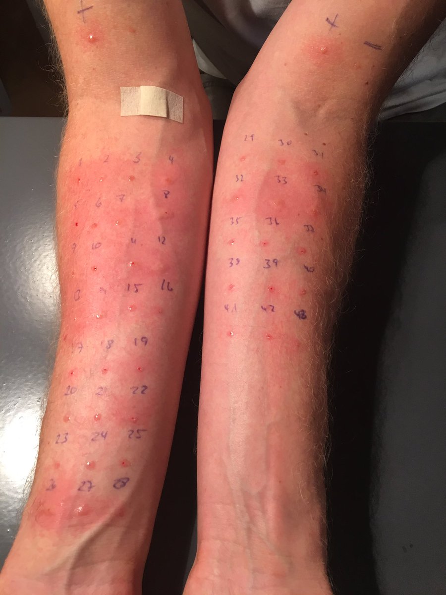 Bei Welchem Arzt Allergietest Quotes Images