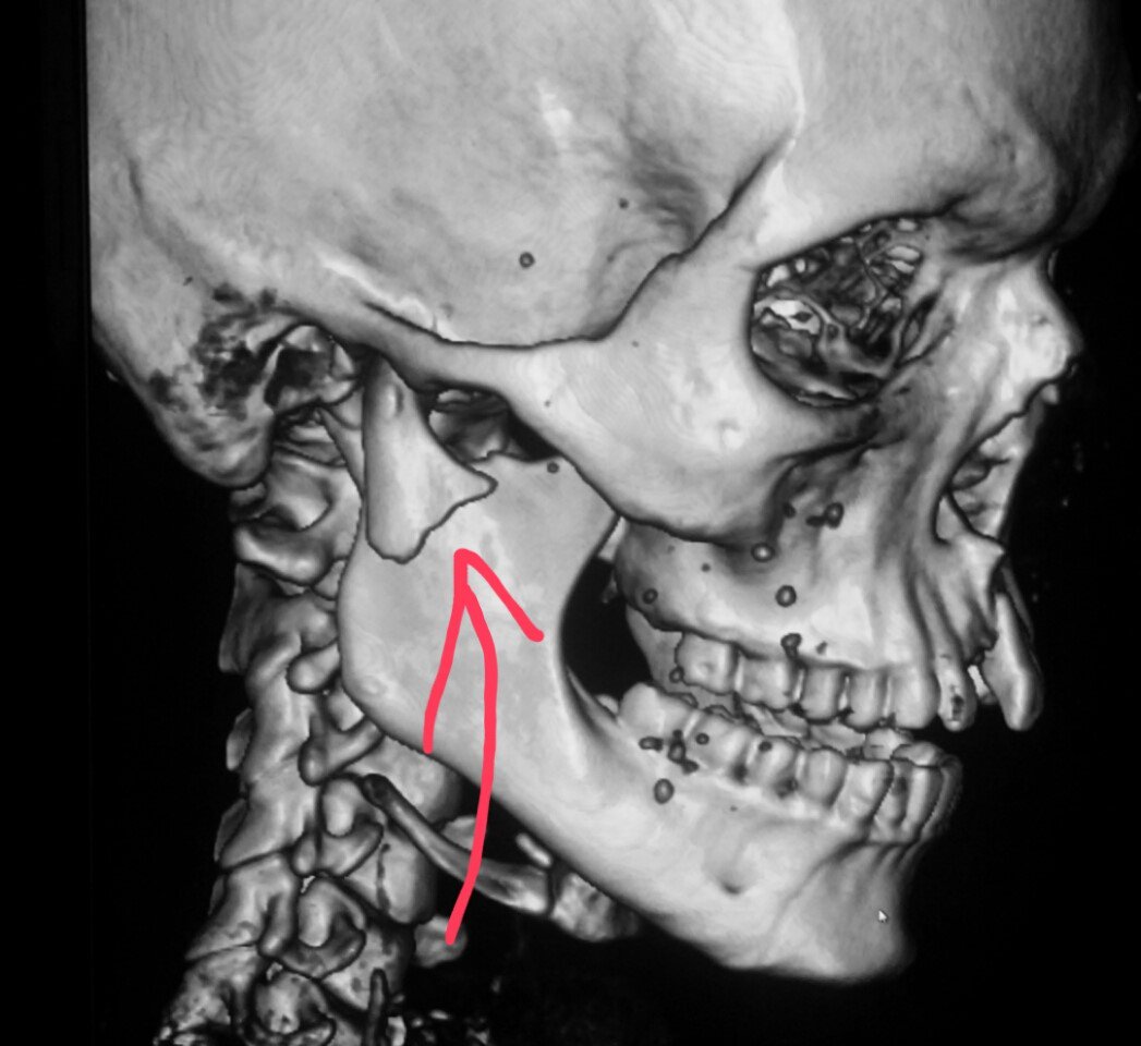 steleRAD's tweet photo. #Face #CT #scan shows
a #jaw (#mandible) #fracture in a #patient who was #punched. #radiologist
#radiology #trauma #pain #injury #assault https://t.co/bEty588oMR