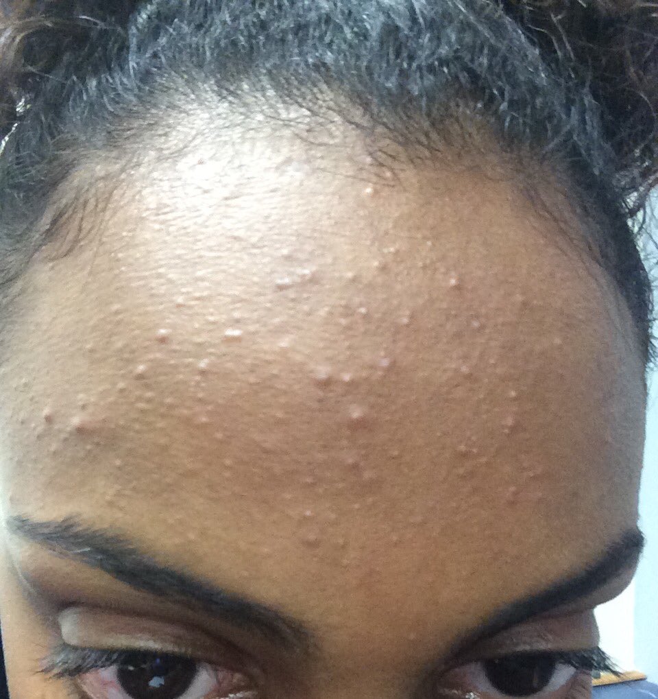 DopeEthiopian's tweet photo. I personally want to thank witch hazel, oxy pads, tea tree oil, bentonite clay, rose water &amp; most importantly drinking water. I love you. 😖💙 https://t.co/eztDRfSr8u