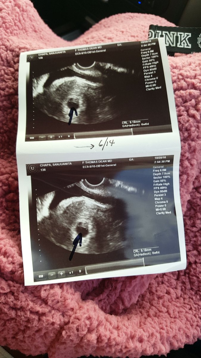 _sstephhanie's tweet photo. Momma is having a baby 😭💕 #7weeksdown https://t.co/XPotrSMrCJ