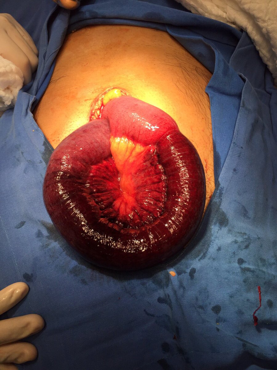 Una que estrangulada es hernia