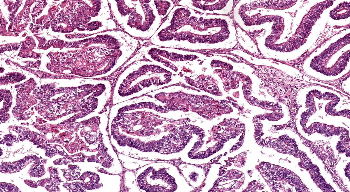 Malignant / Proliferating Brenner Tumor #Pathology #Pathologists #Histology #Histopath