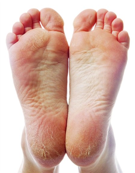 FootstepsClinic's tweet photo. Discover some of the most common reasons for severely cracked heels:
https://t.co/5s4BJ1uDH1 #Feet #FootCare #CrackedHeels https://t.co/81C7FvDp5e
