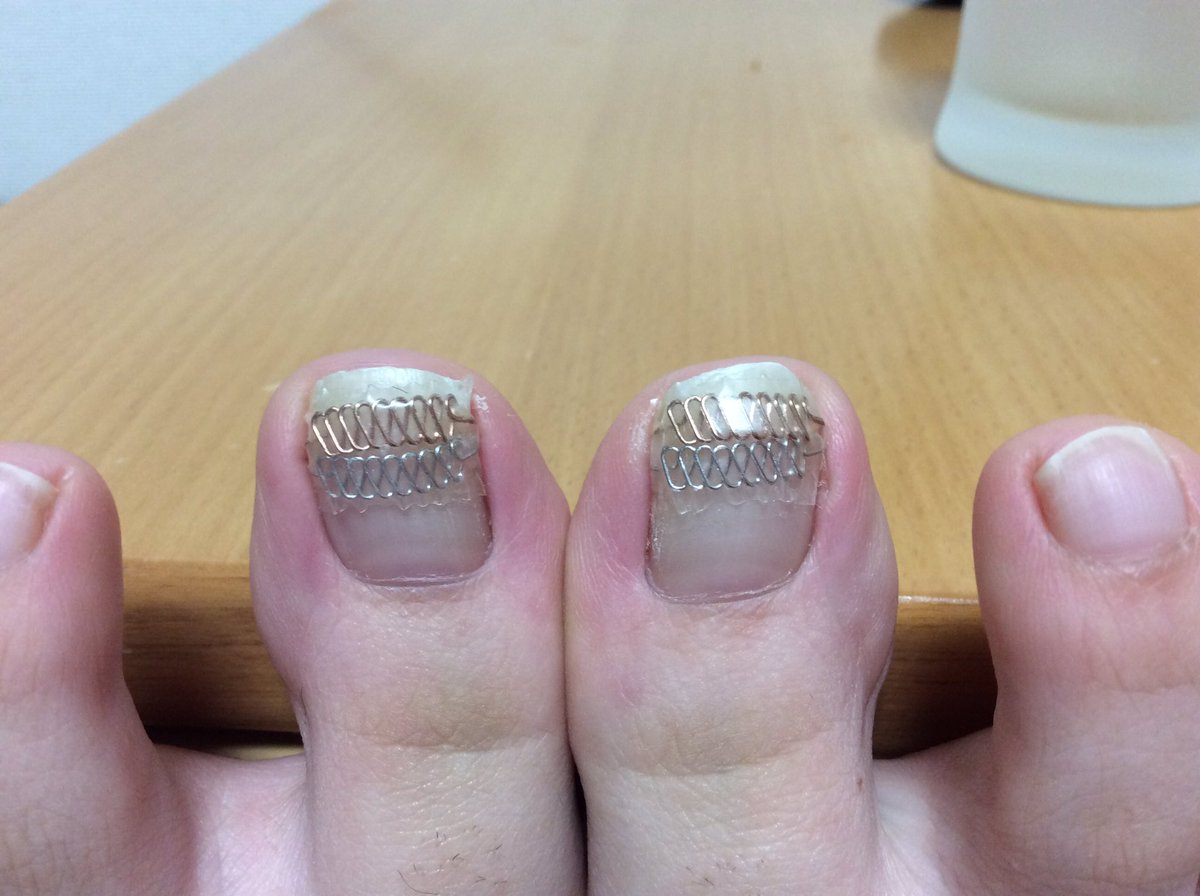 巻き爪ブロック