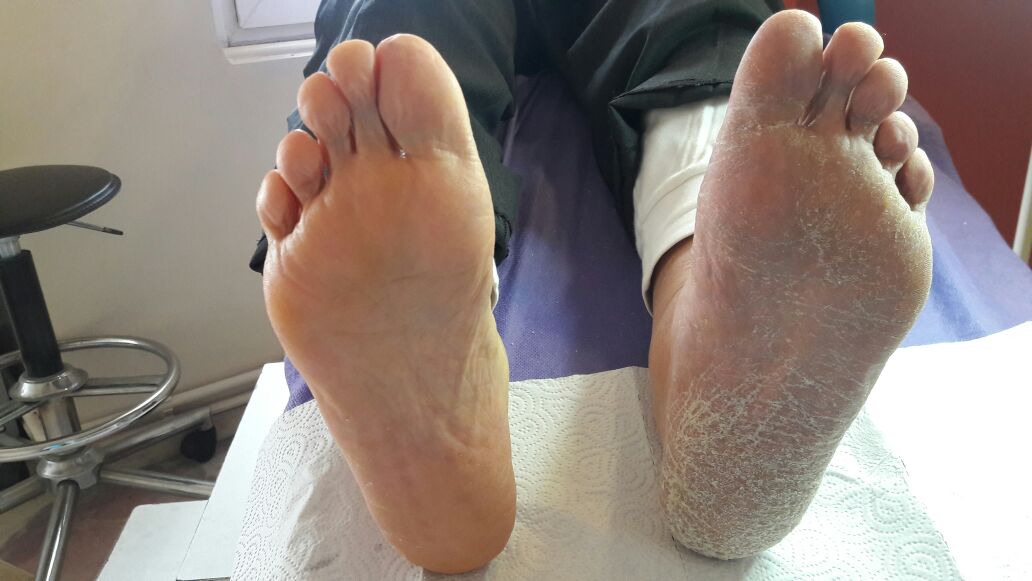 Hastamızın işlem yapılmış ve yapılmamış ayak tabanı.
1 seans sonrası.
Ücretsiz muayene için randevu alınız.