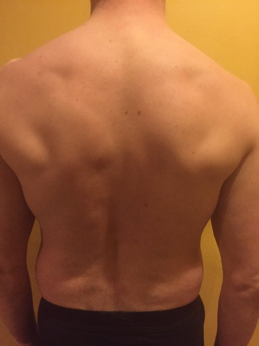 PithersYNHC's tweet photo. #Back #muscle #pain #Sportsmassage #McTimoney #Chiropractic long term reoccurring #injuries #Somerset #CastleCary. https://t.co/hmIxIloNVk