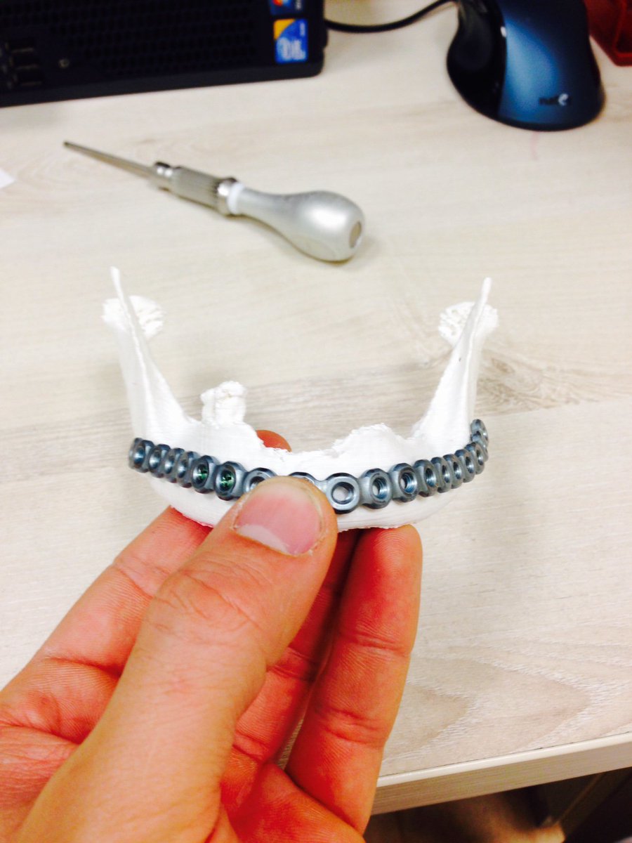 Printmed_3D's tweet photo. #3Dprinting #3DforMedicine #Printmed3D https://t.co/R9BBp71lvP