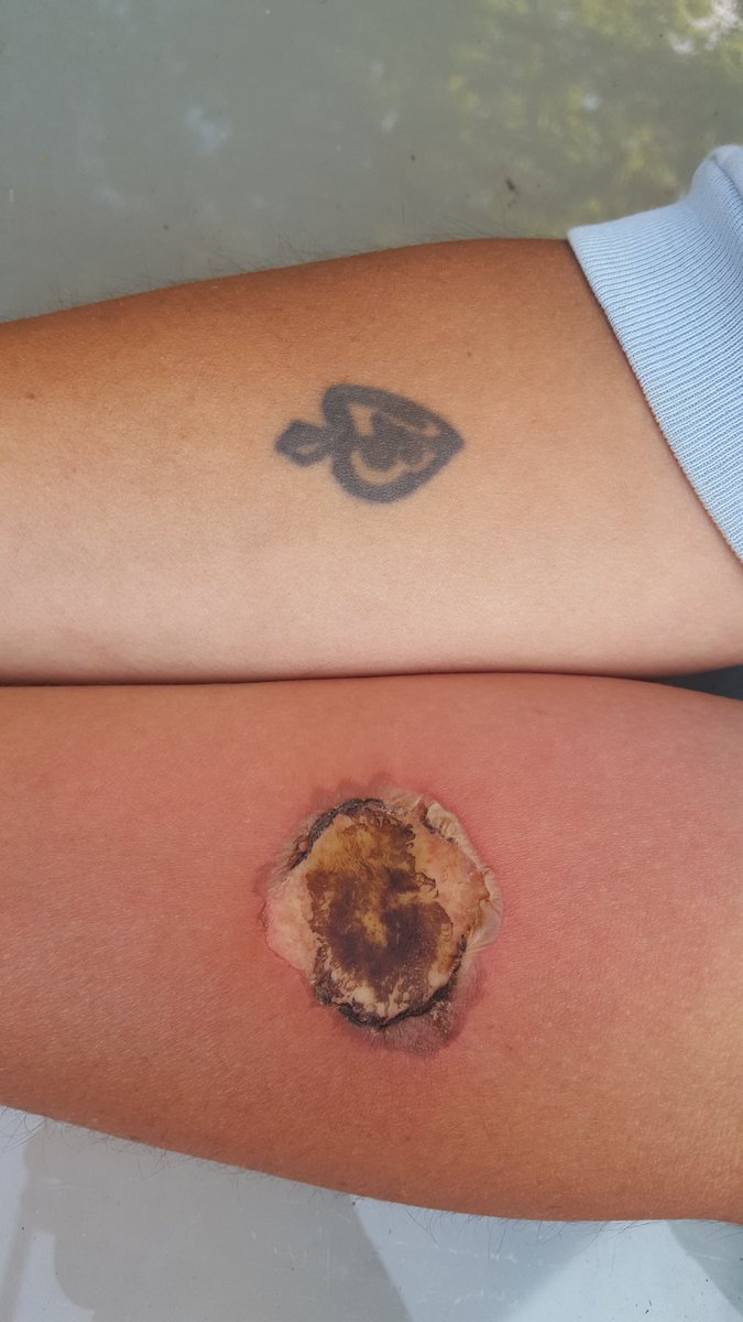 KrisErickson77's tweet photo. Started with a tattoo, ended with a branding! https://t.co/SSgHJqrypl