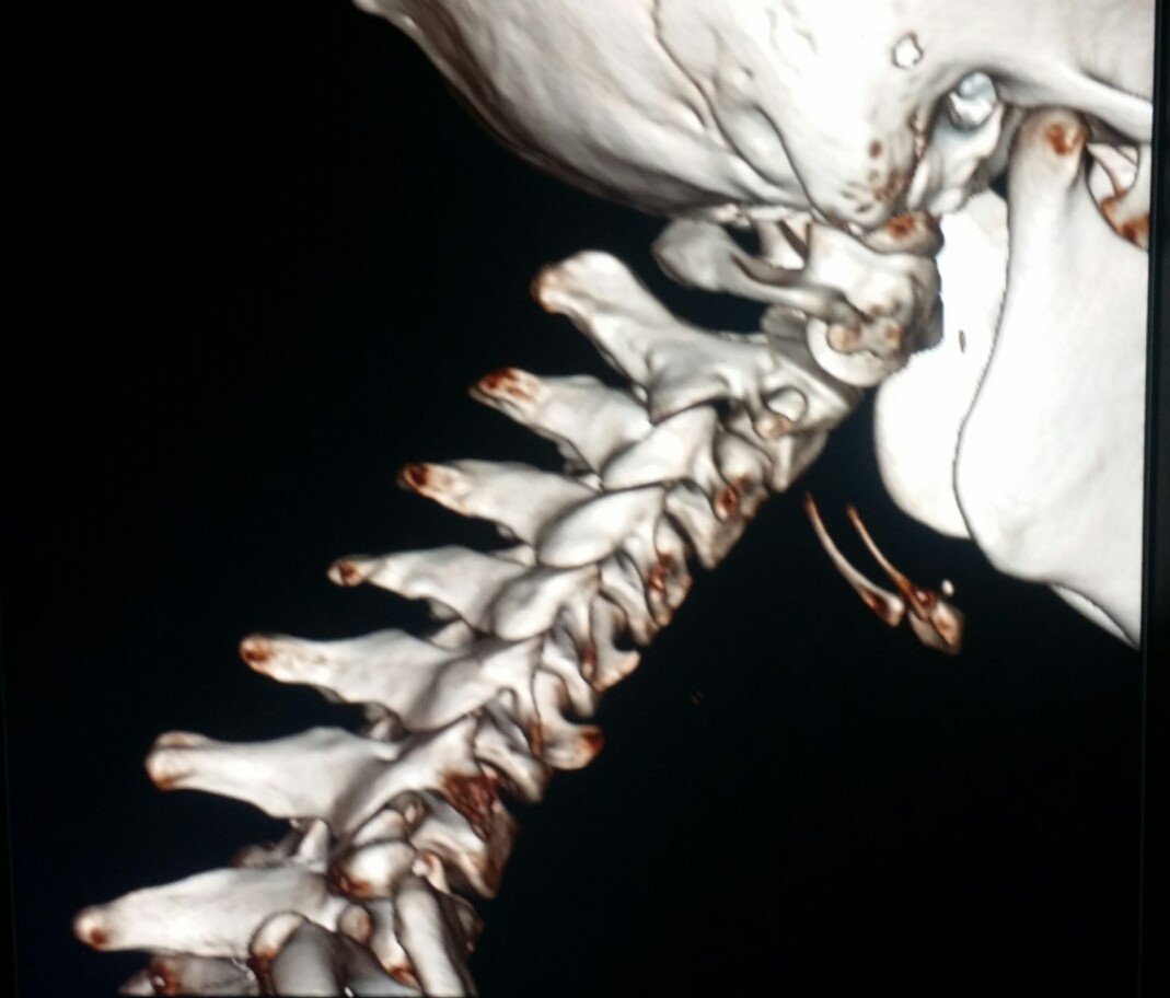 steleRAD's tweet photo. #Normal #CT of the #bones of the #neck in a #patient who was in a #car #accident. #radiologist #radiology #trauma #pain #injury #mva https://t.co/r8Bsnk21hI