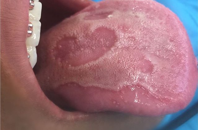 Lengua geográfica o glositis migratoria benigna 
#odontoblog #odontoblogmx