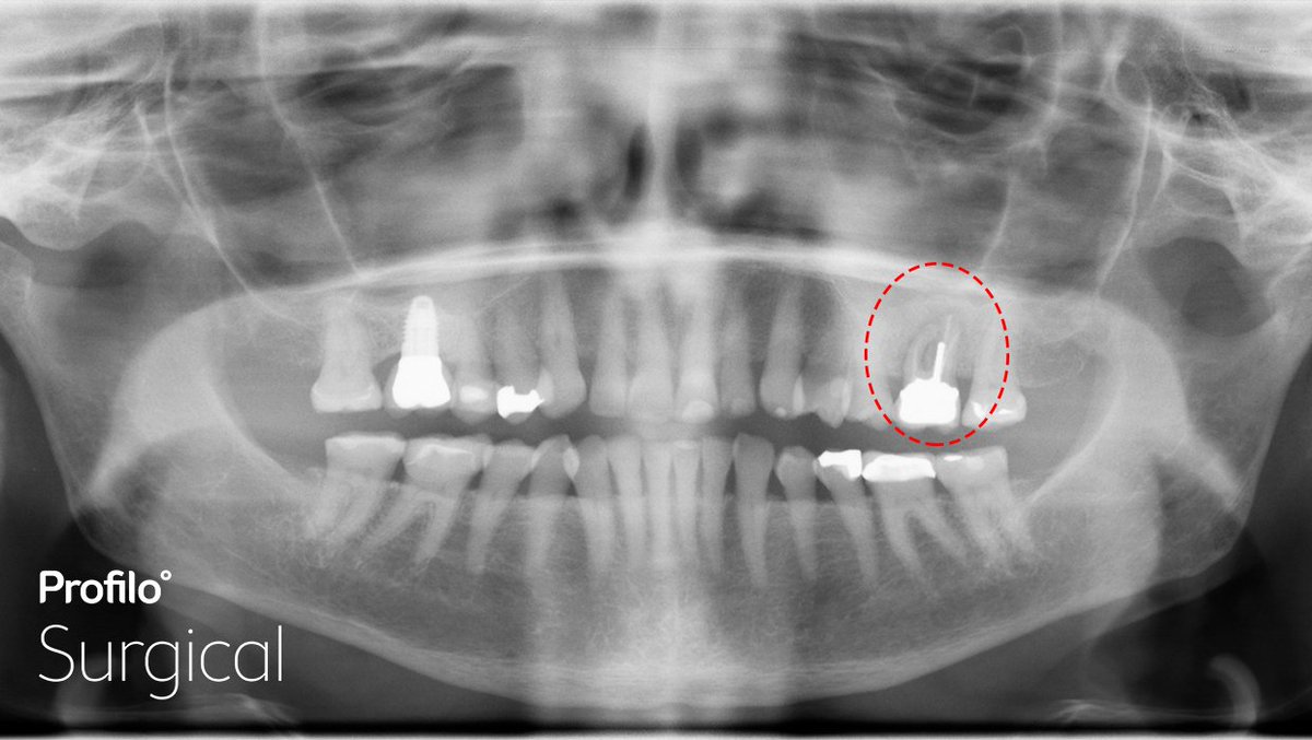 Tooth Abscess Xray