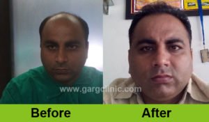 Garg Hair Clinic (@GargClinic) / Twitter Garg Hair Clinic (@GargClinic) / Twitter