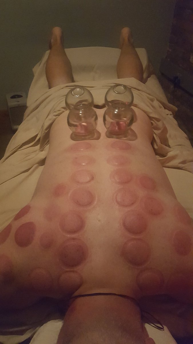 CupHouseChicago's tweet photo. #TrumpProtest #getcupped Rapidly Alleviate chronic pain, stress, depression and anxiety! Results are long lasting #chicago #cuppingtherapy https://t.co/taJbsI8p6A