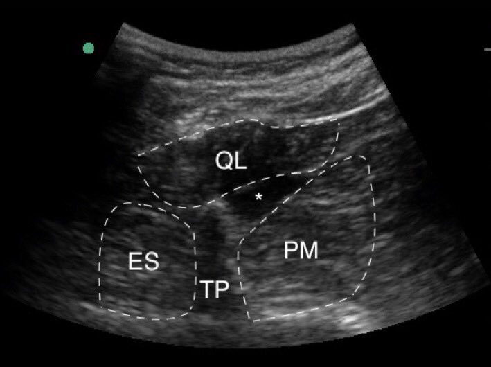 U/S Transmuscular Quadratus Lumborum block- Anterior Thoracolumbar fascial drift and jackknife positioning.  m.bja.oxfordjournals.org/content/117/3/…