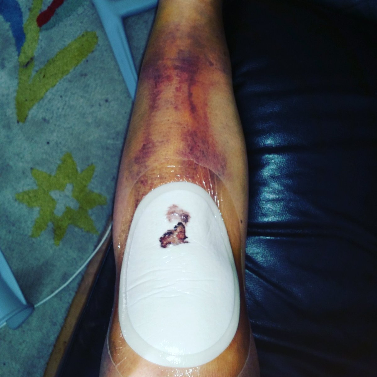 NWiderberg's tweet photo. En vecka sedan imorgon..färggrann och ömt men det går framåt #operation #kneepain #artrosis https://t.co/ouMom1cYbp