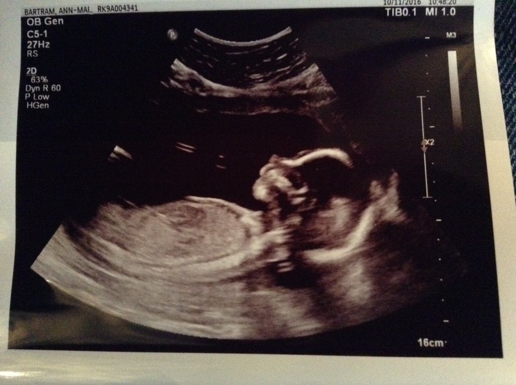 doomsday616's tweet photo. Baby number 5 has a new scan pic can't wait for #2017 it's going to be a great year. #newbaby #scanpic #prouddaddy xx❤️xx https://t.co/yGHX1tu91M
