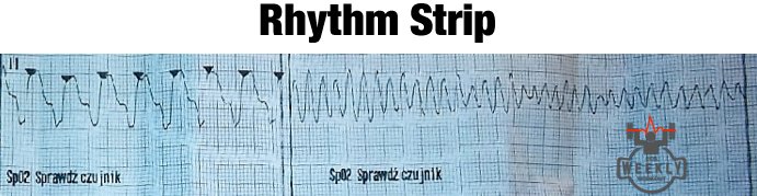 alifarzadmd's tweet image. Synchronized cardioversion of this rhythm caused VFib arrest! 

Learn why here: goo.gl/mVJ6Yh 

#ECGweekly #Cardioversion #Vfib