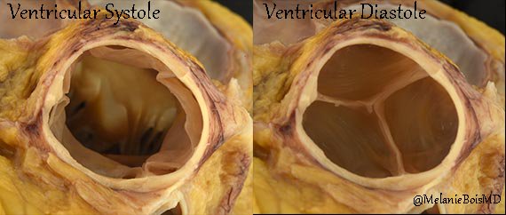 MelanieBoisMD's tweet photo. Normal aortic valve with simulated ventricular systole and diastole #MayoCVPath #CardiacPath @joemaleszewski @JMGardnerMD @LilDocLiz1 https://t.co/UmSpOdZ2p3