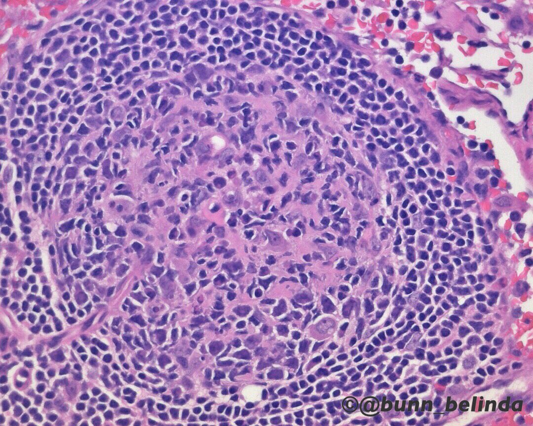 bunn_belinda's tweet photo. Plasma cell infiltration of germinal centers, lymphoid depletion, patent vascular sinuses - advanced immunodeficiency. #pathology https://t.co/EN1xGakYzk