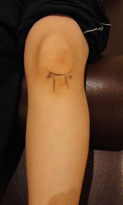 稲穂針灸 接骨治療院 数日前から膝に違和感 昨晩突然歩行困難な痛み出現 痛みが強くボルタレン内服薬 塗り薬 湿布 お灸を実施 全て無効果で稲穂に施術依頼 原因解らない場合医科検査条件で 問 触診検査でhoffa病 膝蓋下脂肪体炎 と考え施術