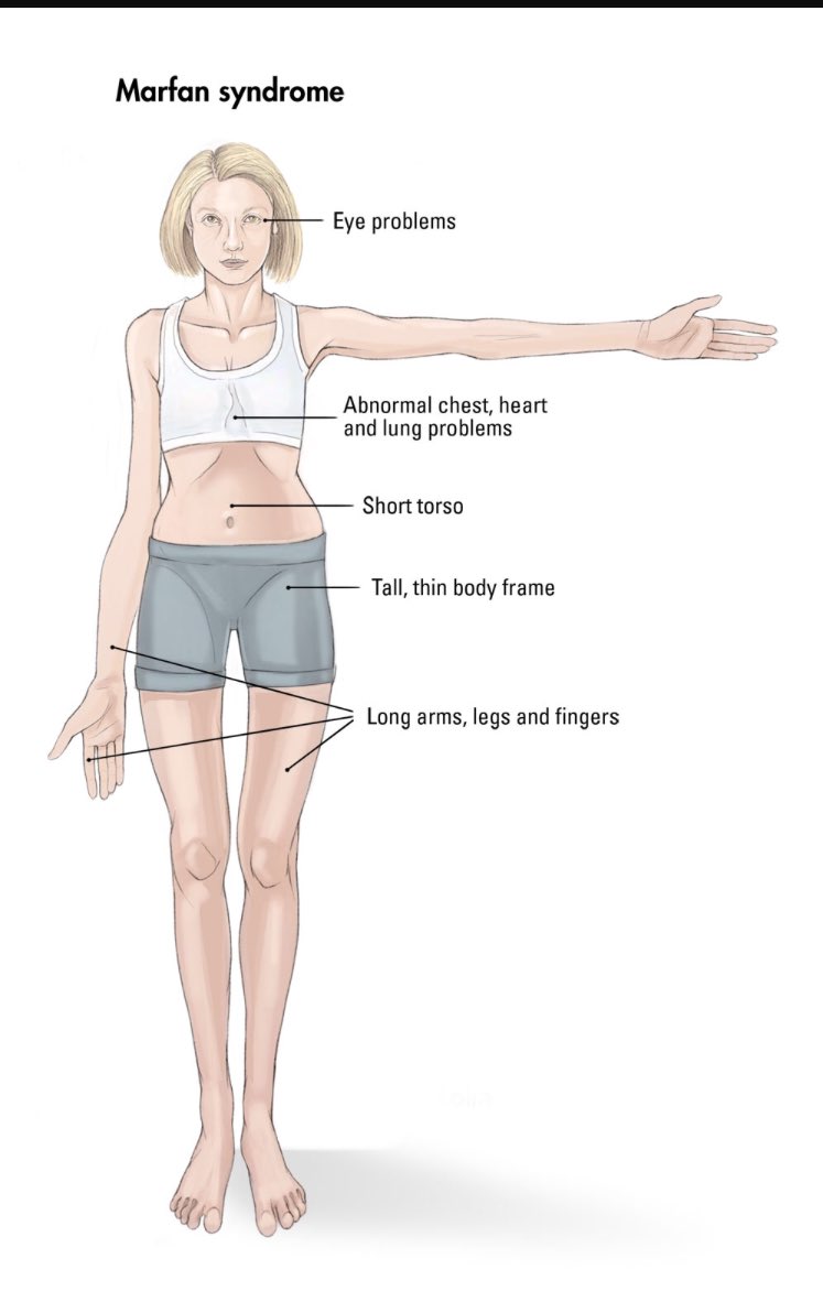 Syndrome Marfan Syndrome Marfan تويتر