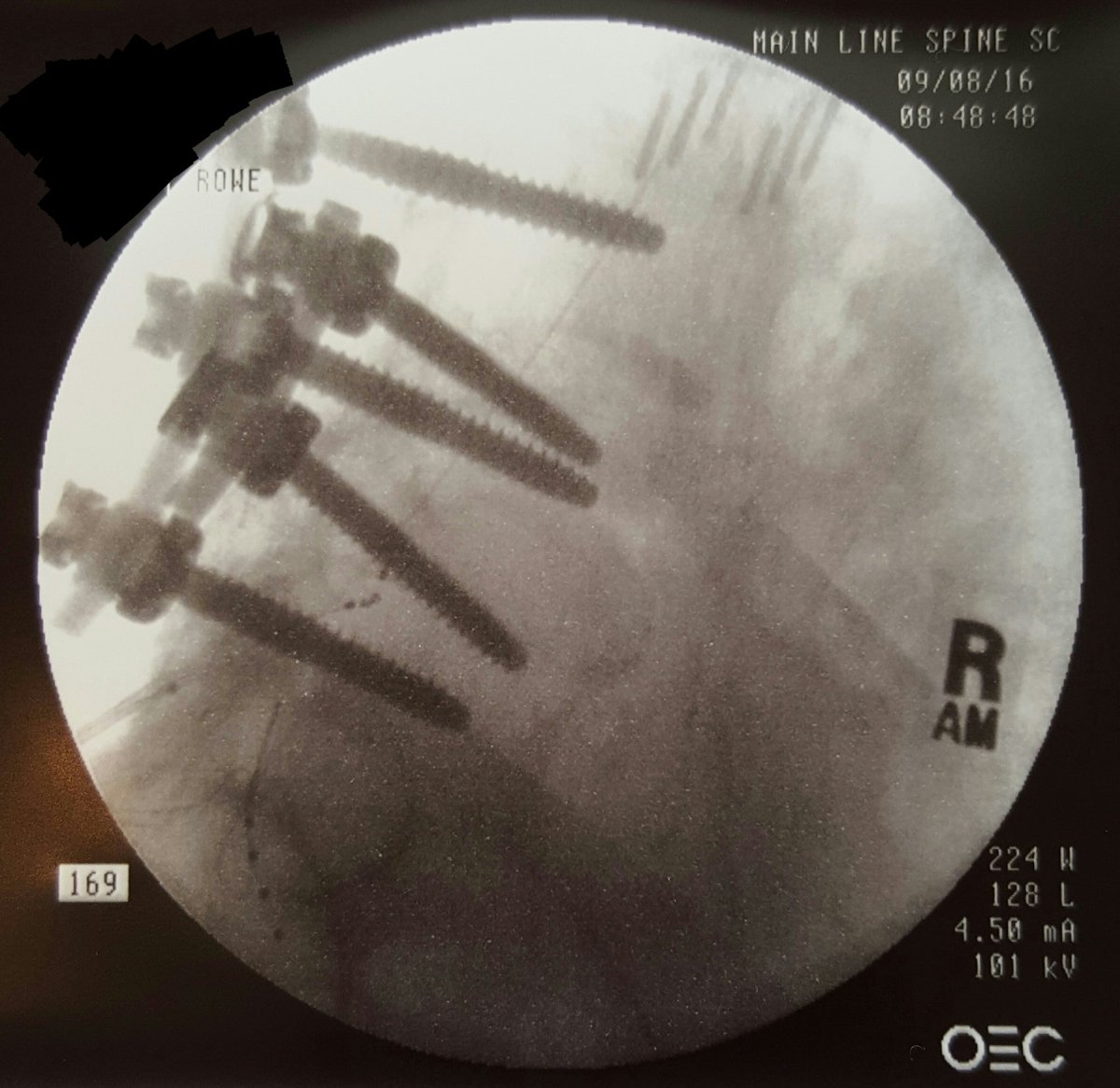 JefferyRoweMD's tweet photo. CRPS Right Foot (S1 Lead) and Right Ankle (L5 Lead) and Right Low Back Pain (T11 Lead)... Now 100% Pain Free After DRG Stimulator Implant. https://t.co/APiW66tLjv