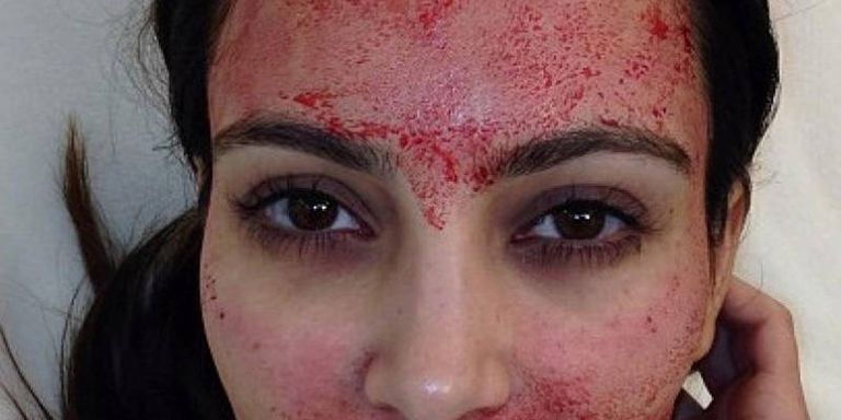 #Halloween might be over for another year, but interest in vampires are on the rise... #vampirefacials, that is! aestheticmed.co.uk/site/industryn…