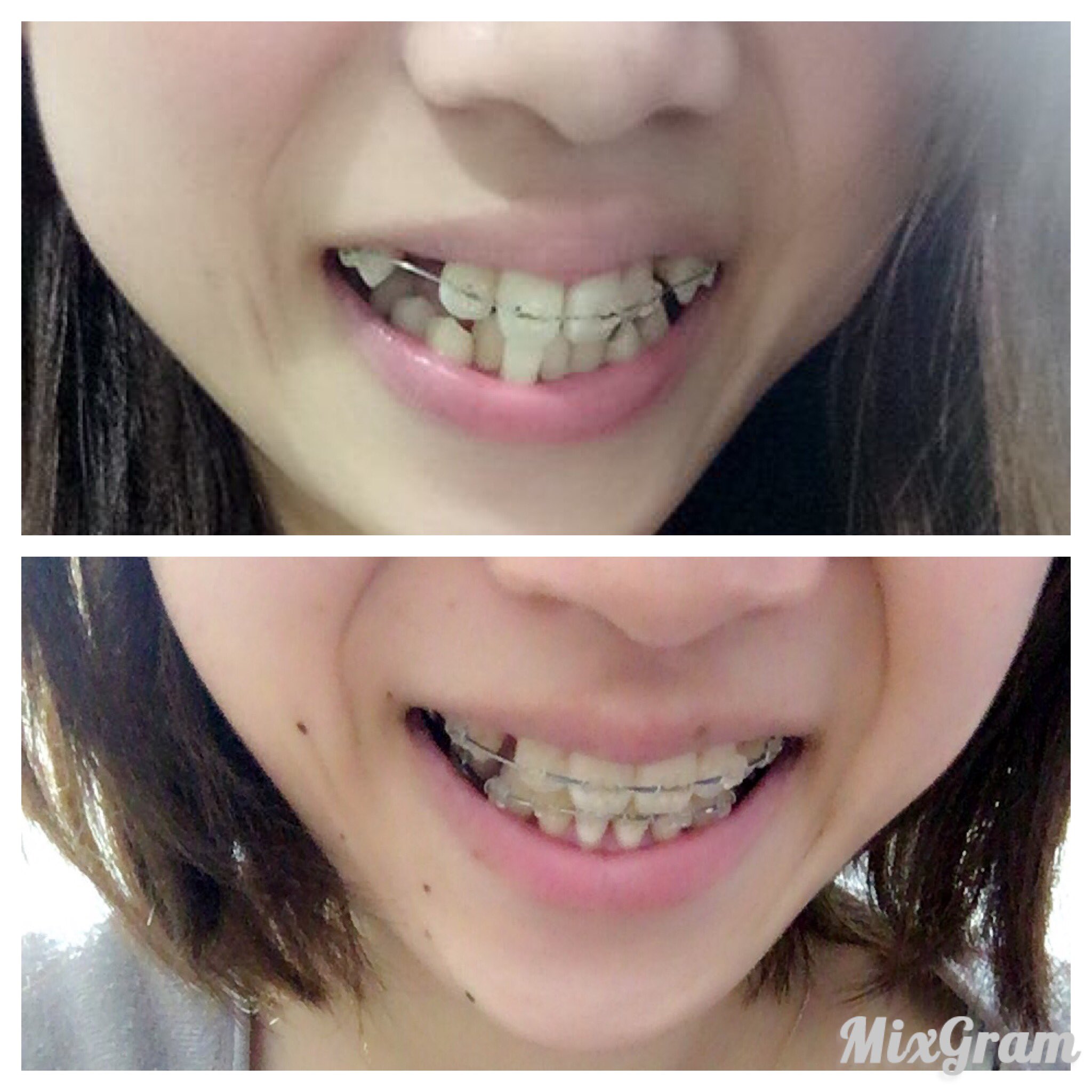 てん そういえば 矯正始めてしれっと一年経った W و و 始める前は虫歯とか 抜歯矯正 は老け顔なるとか痛そうとか不安いっぱいやったけど特に問題もなく快適矯正ライフ ブラケットにも愛着あるぜ 一年前の写真と並べると嬉しくってにやにやする